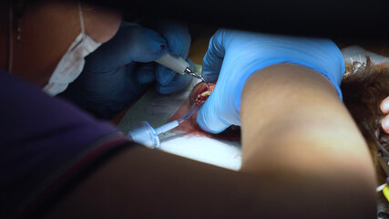 Dog is having a teeth clean on the surgical table. Sanitation of the oral cavity in dogs. Dentist vet treated teeth, the animal is under anesthesia in a veterinary clinic. Veterinary stomatology