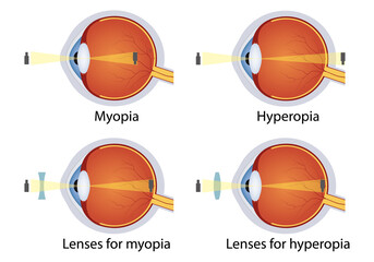 Hyperopia and myopia corrected by lens. Concept of eyes defect. Correction of various eye vision disorders by lens. - obrazy, fototapety, plakaty
