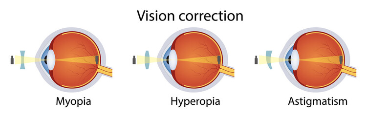 Correction of various eye vision disorders by lens. Hyperopia, myopia, astigmatism. Vector illustration © Toxa2x2