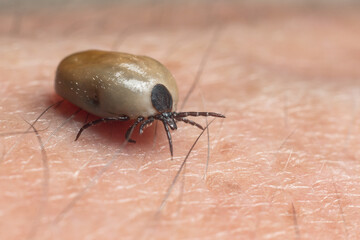 A tick drunk on blood crawls on human skin
