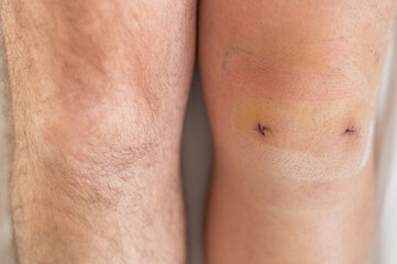Close-up of a surgical suture on the knee after laparoscopic minisk surgery. Male legs after surgery