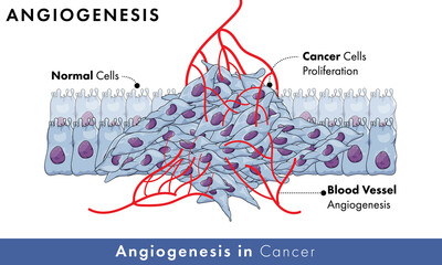 Growth of blood vessel in cancerous tissue or cells which is also known as angiogenesis with normal cells in background,.
