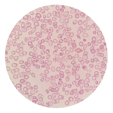 Microscopic images of abnormal red blood cells from thalassemia patient. Erythrocytes morphology in thalassemia.