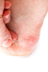 Blister on heel gets pricked with needle to burst it on white background, close-up with selective...