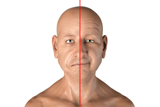 Facial nerve paralysis