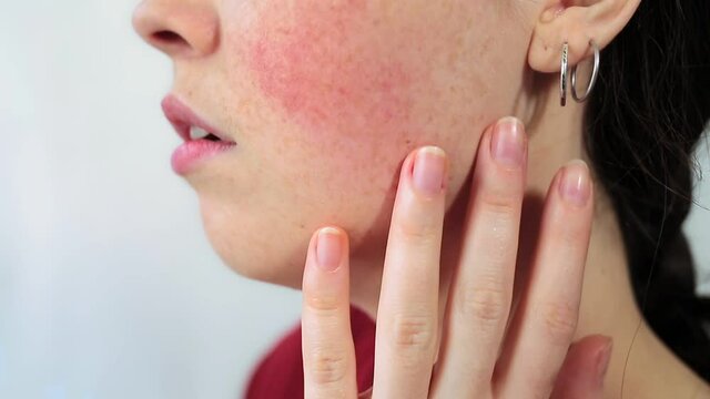 Portrait in profile close-up of a young woman with a large redness on her cheek, feeling the inflammation with her finger. White background. The concept of rosacea and couperose