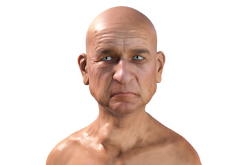 Thyroid cancer, tumor inside thyroid gland