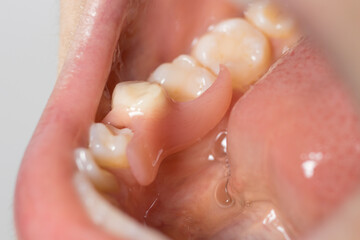 Artificial tooth removable prosthesis in the patient's mouth. Inserted a solitary fake molar in dentistry.