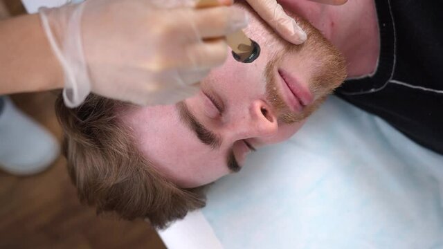 Master doctor performs procedure removing unwanted facial hair in bearded man with wax.