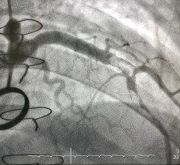 coronary angiogram shown massive thrombus that occluded left anterior descending artery (LAD) in...