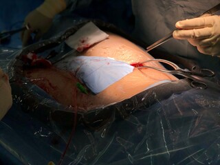 Surgeon was puncture to femoral artery by arterial cutdown technique.