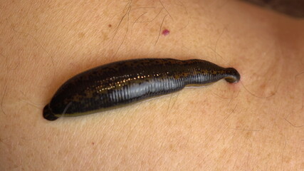 Medical leech on the human body drink blood. Treatment with leeches. Macro video.