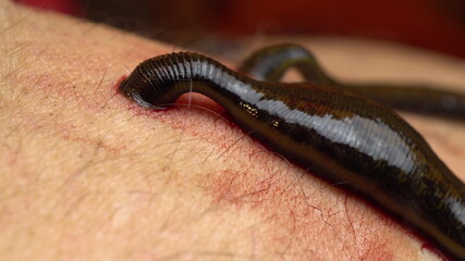 Medical leeches on the human body drink blood. Treatment with leeches. Macro video.