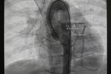 pediatric angiography. Aortography showed patent ductus arteriosus (PDA), which is congenital heart disease, in cardiac catheterization room.