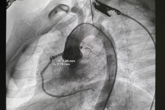 pediatric angiography. Aortography showed patent ductus arteriosus (PDA), which is congenital heart disease, in cardiac catheterization room.
