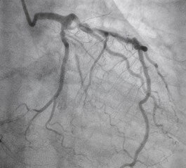 Coronary angiogram , medical x-ray for heart disease. Coronary artery disease.	
