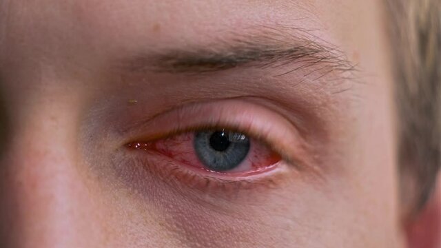 Close up of annoyed twitching red blood blue eye of male affected by conjunctivitis or after flu, cold or allergy. Concept of health, disease and treatment. Irritated eye full with capillar net