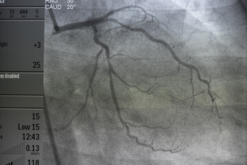 Coronary angiogram , medical x-ray for heart disease. Coronary artery disease.	