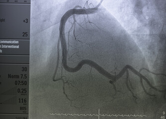 Coronary angiogram , medical x-ray for heart disease. Coronary artery disease.	
