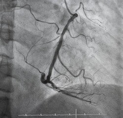 Coronary angiogram , medical x-ray for heart disease. Coronary artery disease.	