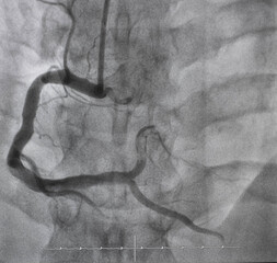Coronary angiogram , medical x-ray for heart disease. Coronary artery disease.	