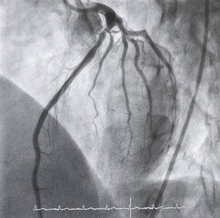 Coronary angiogram , medical x-ray for heart disease. Coronary artery disease.	