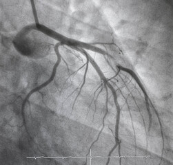 Coronary angiogram , medical x-ray for heart disease. Coronary artery disease.	