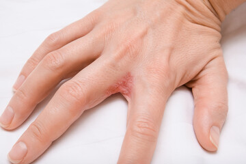Hand with interdigital dermatitis, dyshidrotic eczema on hand close up