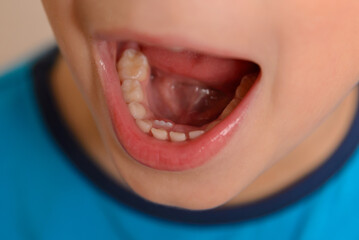 A new tooth is growing, but the old one has not yet fallen out. Close-up of the mouth