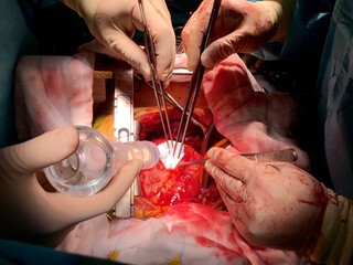 Surgeon used dacron patch for closure of Ventricular septal rupture (VSR) in acute myocardial...