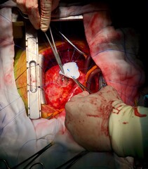 Surgeon used dacron patch for closure of Ventricular septal rupture (VSR) in acute myocardial...