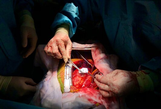Surgeon used dacron patch for closure of Ventricular septal rupture (VSR) in acute myocardial infarction (MI) patient with cardiopulmonary bypass (CPB) support.