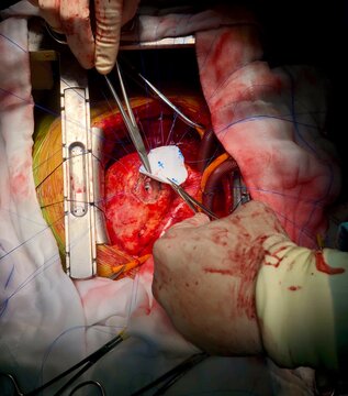 Surgeon used dacron patch for closure of Ventricular septal rupture (VSR) in acute myocardial infarction (MI) patient with cardiopulmonary bypass (CPB) support.