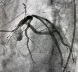 coronary angiogram of left coronary artery with arteriovenous (AV) fistula from left anterior descending artery (LAD).