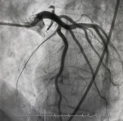 Obraz premium coronary angiogram of left coronary artery with arteriovenous (AV) fistula from left anterior descending artery (LAD).