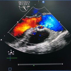 Transesophageal echocardiogram (TEE) shown Aortic va, e (AV) opening in parasternal long axis view...