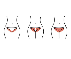 Bikini area depilation. Silhouette of a woman. Vector illustration.