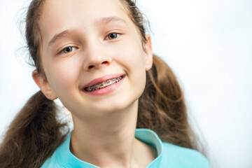 Closeup metal brackets on teeth. Beautiful female smile with braces.