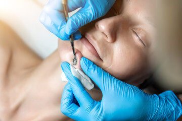 Close-up detail of beautician doctor hand in blue rubber protective gloves make blackhead spot pimples removal procedure for young adult female patient. Woman facial cleansing and skin care concept