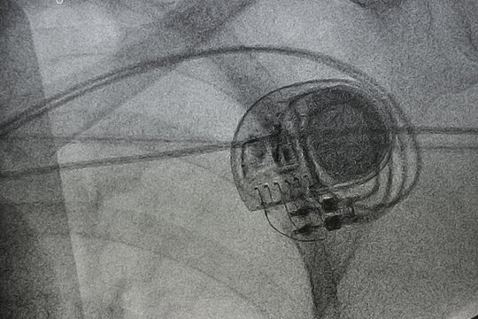 x-ray image of permanent pacemaker implant in chest body	