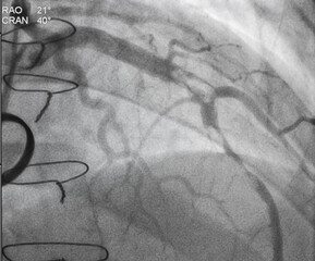 Coronary angiogram , medical x-ray for heart disease. Coronary artery disease.