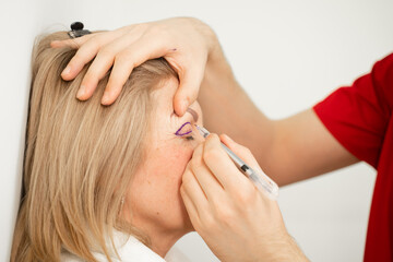 Blepharoplasty markup close-up on the face before the plastic surgery operation for modifying the...