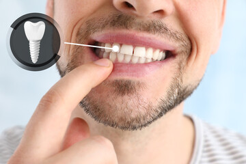 Man showing implanted teeth on light background, closeup - obrazy, fototapety, plakaty