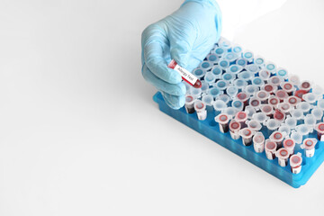 Doctor with allergy test in laboratory