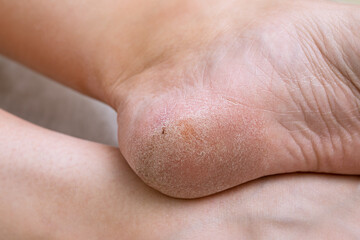 Naklejka premium Problematic diabetic foot in a woman. Dry feet and cracked heels of a sick person.