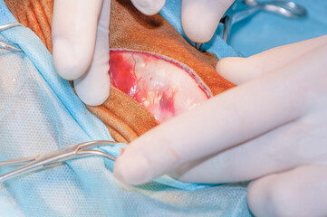 Hemorrhage into subcutaneous fat. Subcutaneous hematoma. Surgery. The skin incision shows an injury