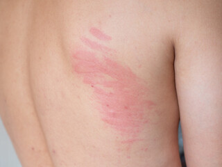 Skin allergic and itchy on the back of sick person