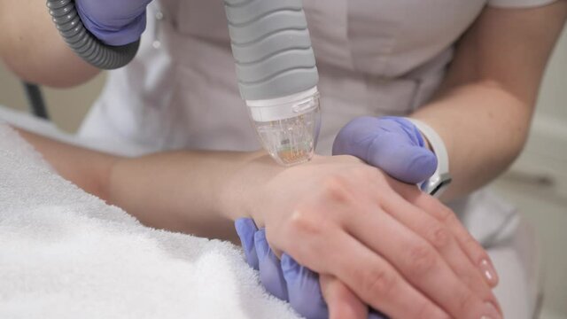 Caring beautician doctor in protective gloves treating wart on beautiful female hands with medical laser. Hardware methods of skin regeneration and rejuvenation.