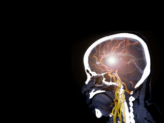  CTA brain or CT angiography of the brain  fusion 2D and 3D Rendering image . medical technology concept.
