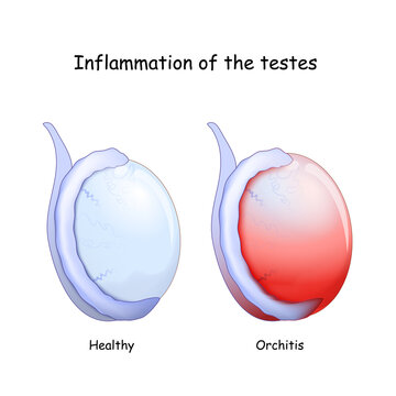 Healthy testicle and testicle with Orchitis